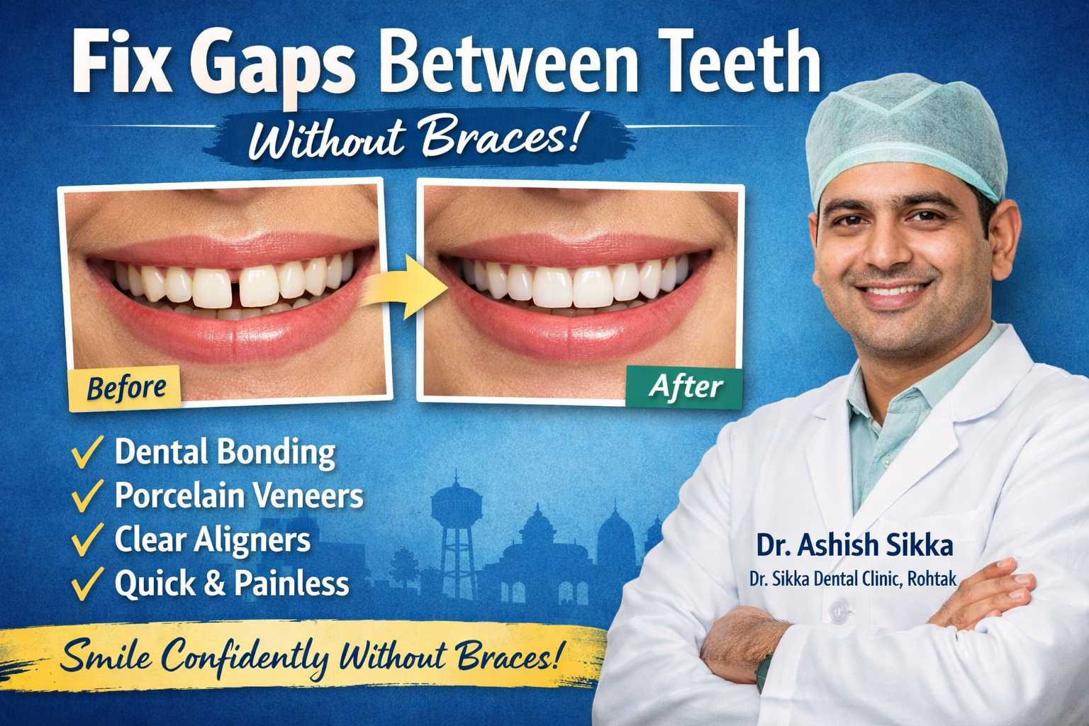 How to Fix Gaps Between Teeth Without Braces