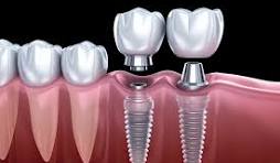Dental Implant